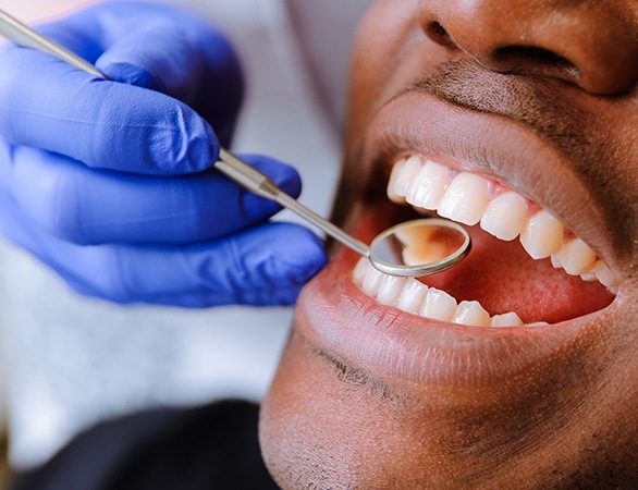 Smile examined after mercury-free filling