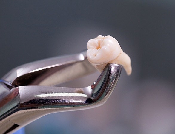 Clasp holding an extracted wisdom tooth
