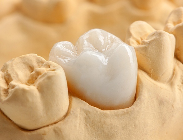 Dental crown covering a tooth in a model of the mouth