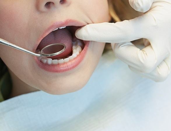 Closeup of child receiving dental sealants