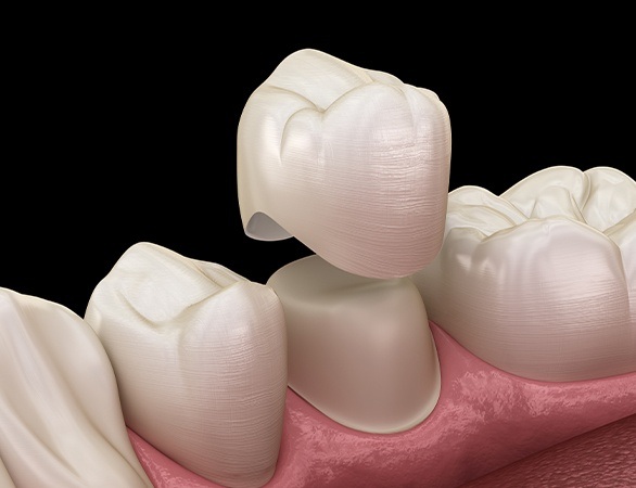 Animated dental crown placement