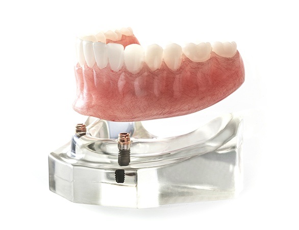 Model implant overdenture