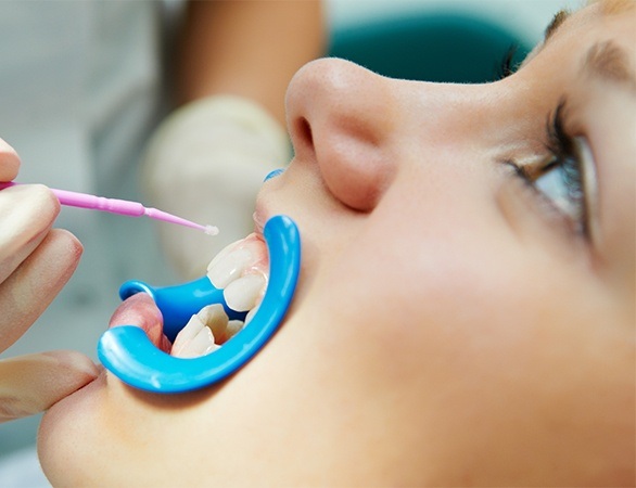Child receiving fluoride treatment in dental chair