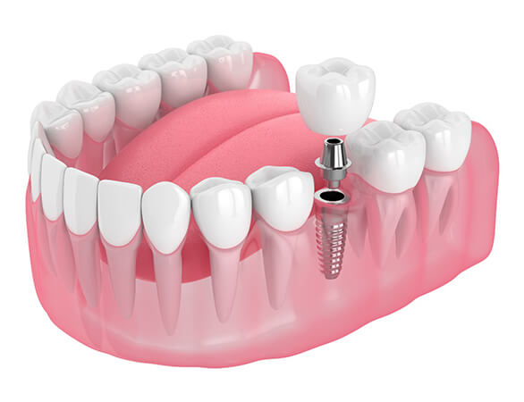 Illustration of single implant being placed into jaw