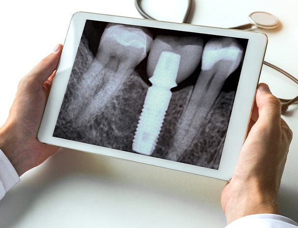 X-ray of implant supported dental crown