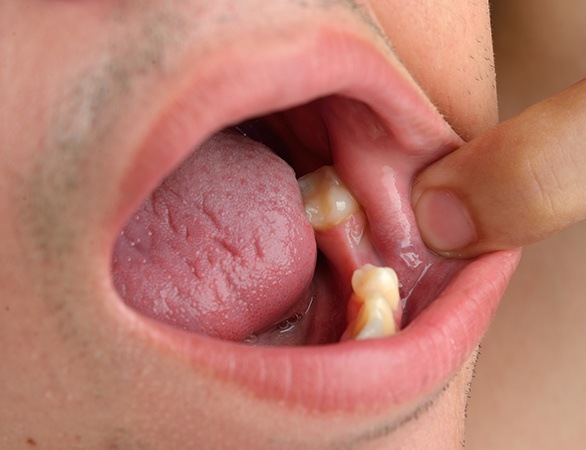 Closeup of smile with missing bottom tooth