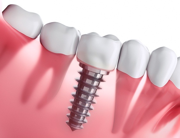 Animated implant supported dental crown