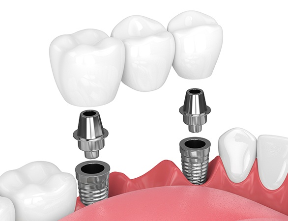 An imated implant supported dental bridge