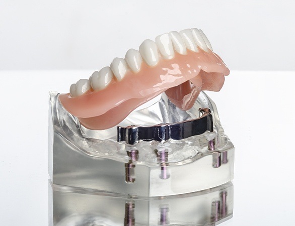 Model dental implant supported denture