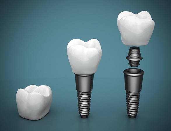 Animated parts of a dental implant replacement tooth