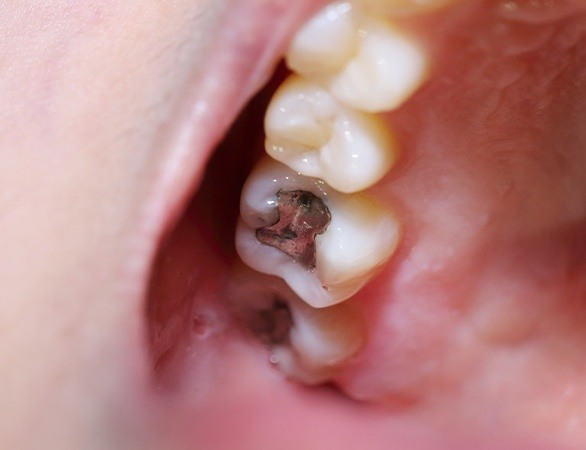 Closeup of tooth with traditional amalgam filling