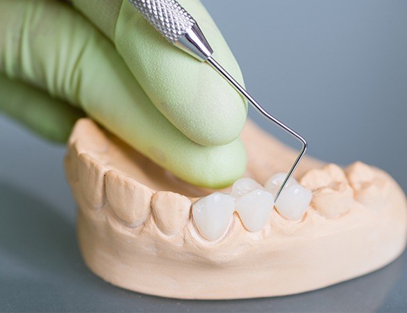 Model smile with dental bridge restoration