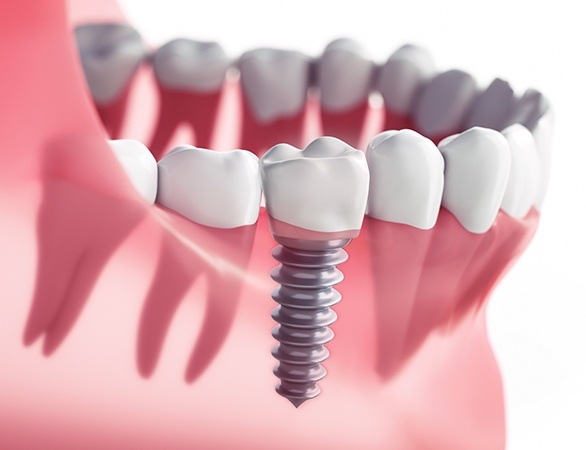 Animated implant supported dental crown