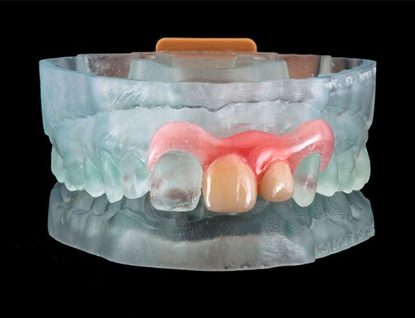 Model smile with Valplast partial denture