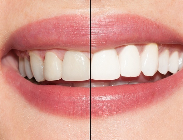 Smile before and after teeth whitening